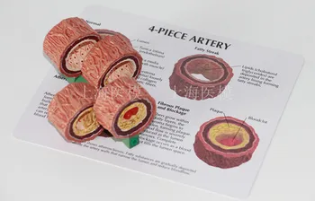 4-Etapas Skerspjūvio Žmogaus Arterijų Aterosklerozės Anatomijos Režimas Trombozinių procesas